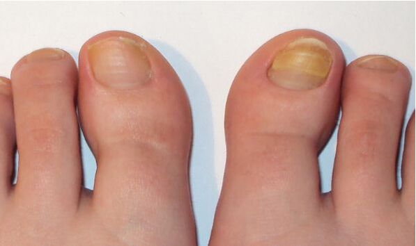 symptoms of toenail fungus