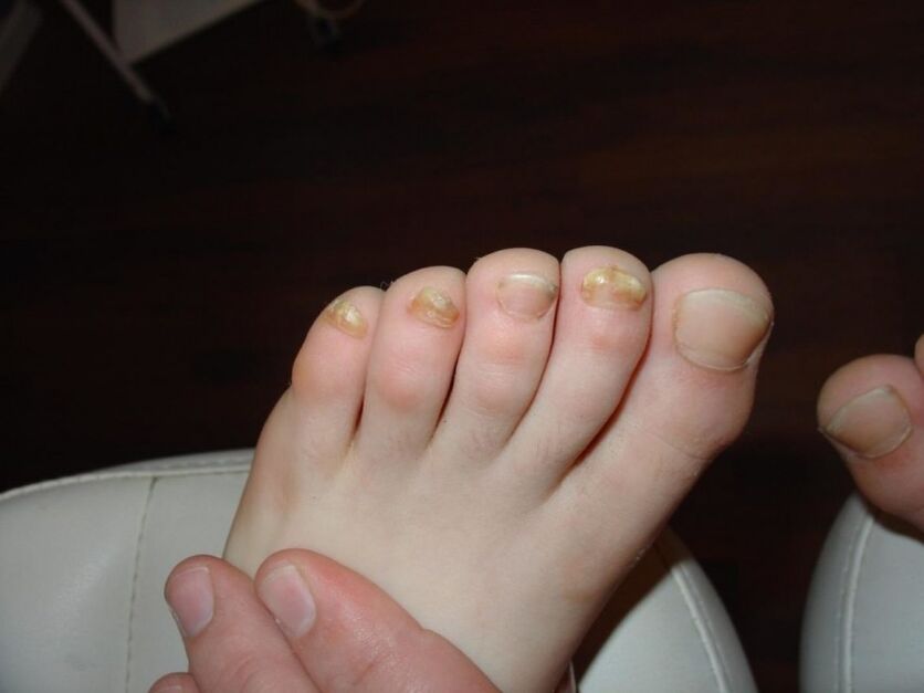 symptoms of toenail fungus