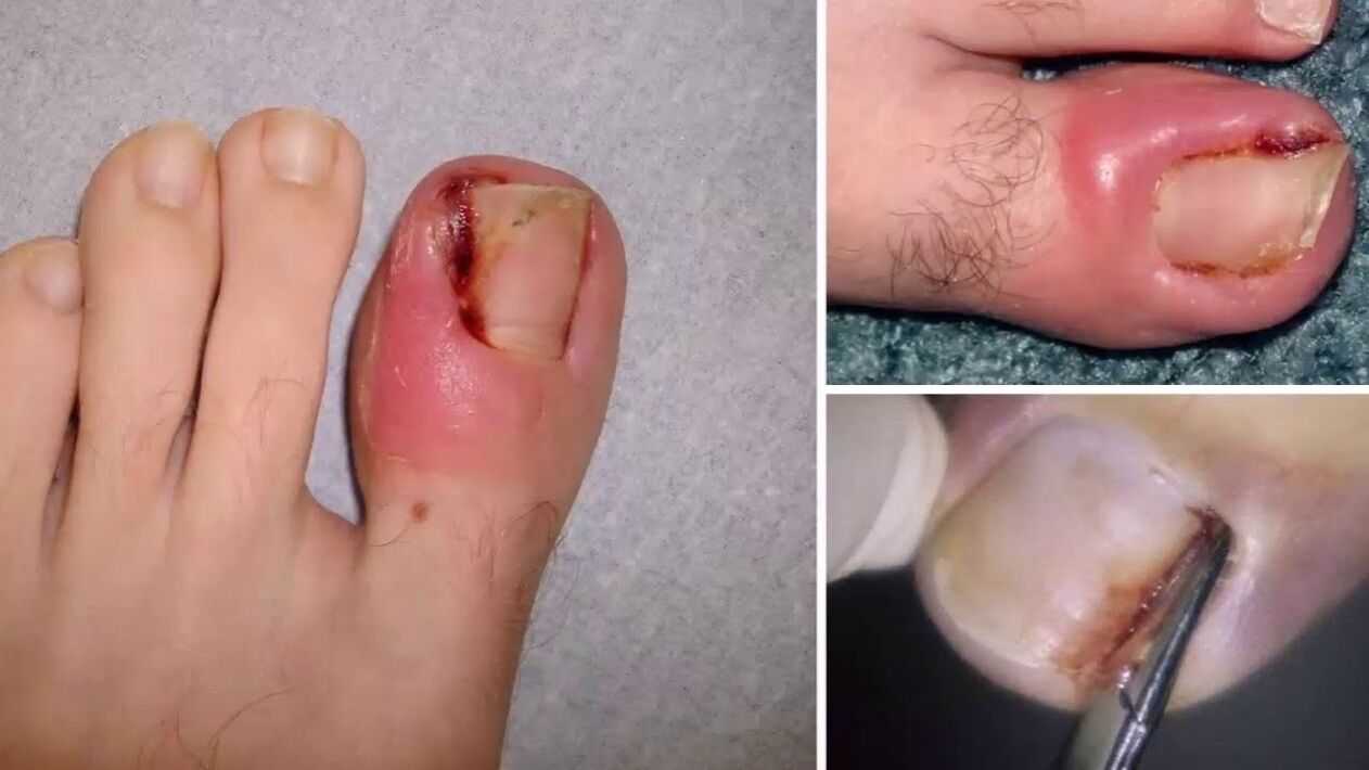 complications from nail fungus