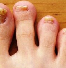 Nail foot