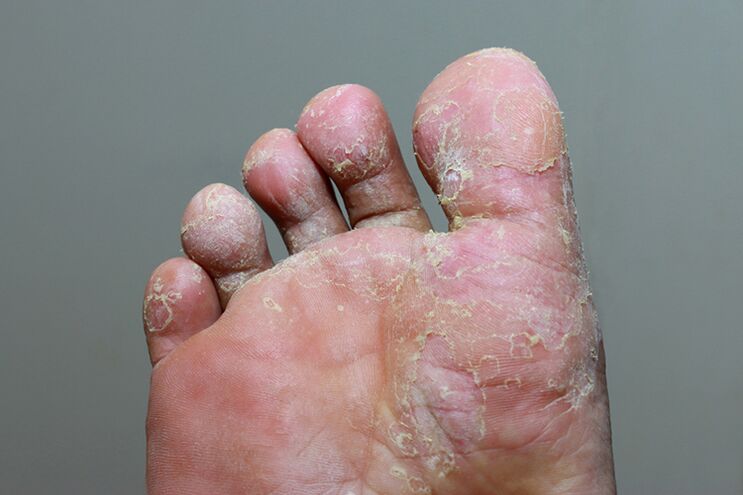 A heavy stage of mycosis of the skin of the finger