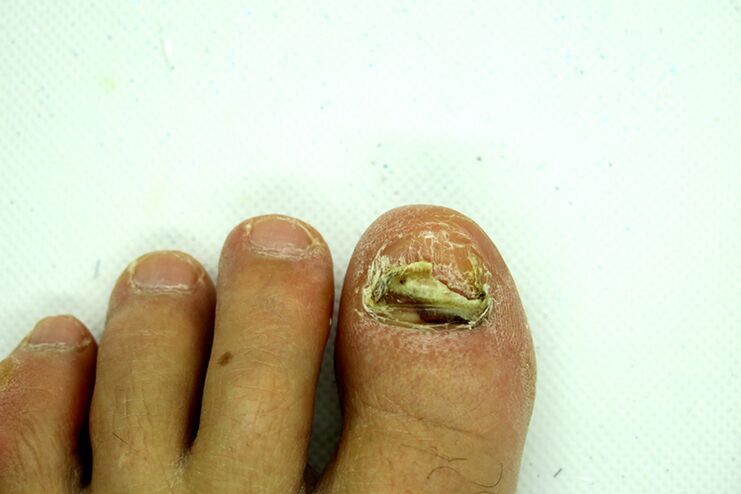 Finger Nail fungus - a heavy scene