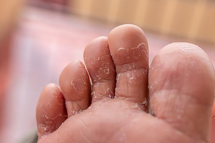Skin fungus - initial stage