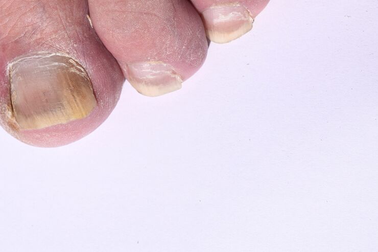 The initial stage of mycosis of the toenails