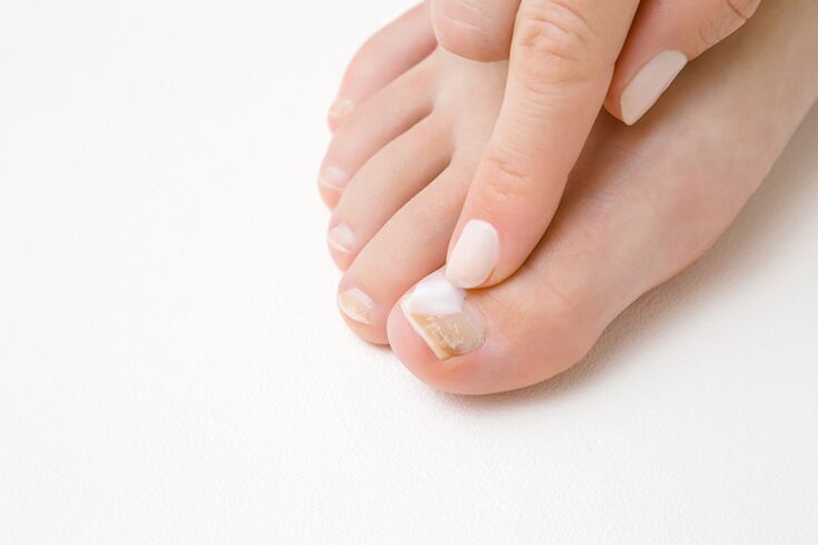 Treatment of finger with an ointment from the fungus