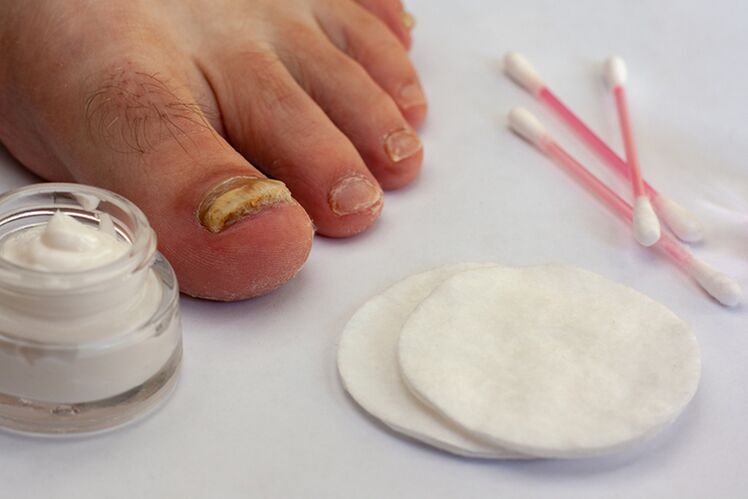 Treatment of fungi with fingers with fungi cream