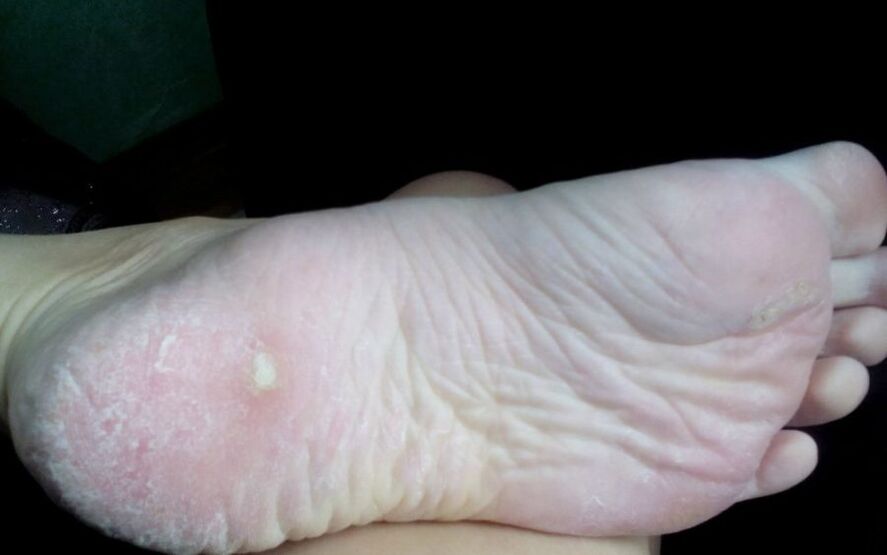 What does the fungus look and manifest