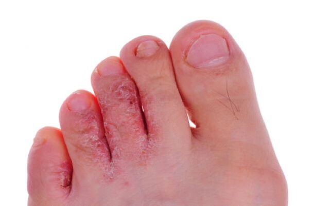 fungal diseases of the toes