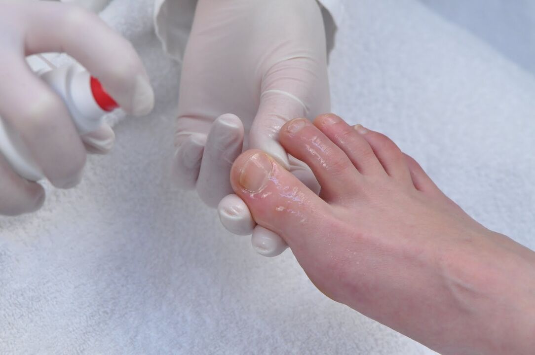 treatment of toenail fungus