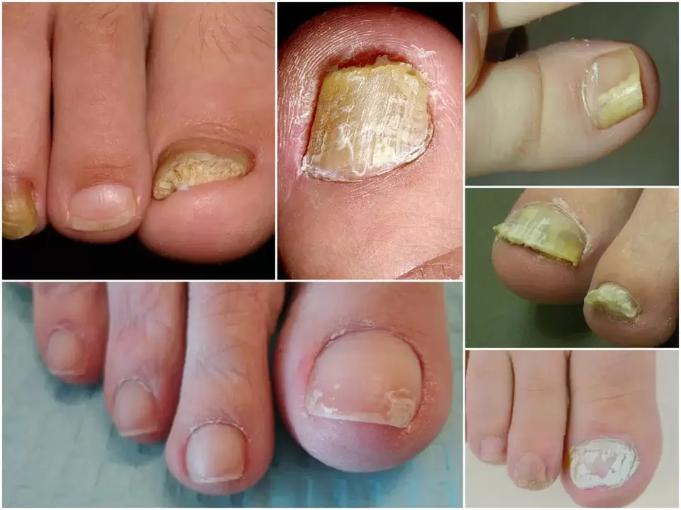 Occurrence of various forms of onychomycosis