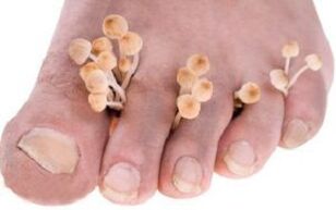 Onychomycosis of the toenails