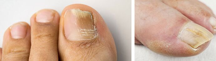 photo of fungal infection of the nail of the big toe