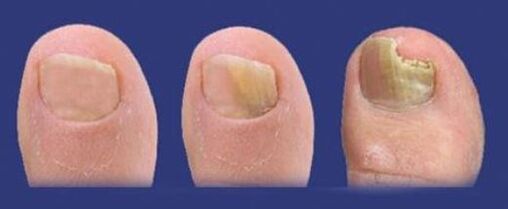 stages of development of the fungus on the toenails