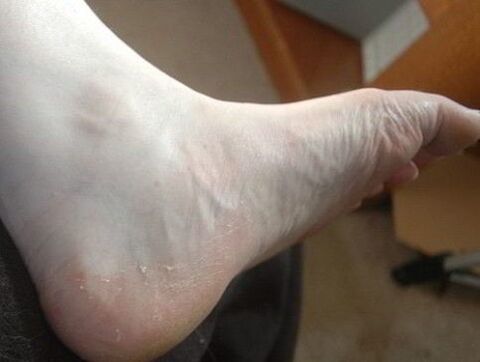 peeling of the foot as a sign of a fungal infection